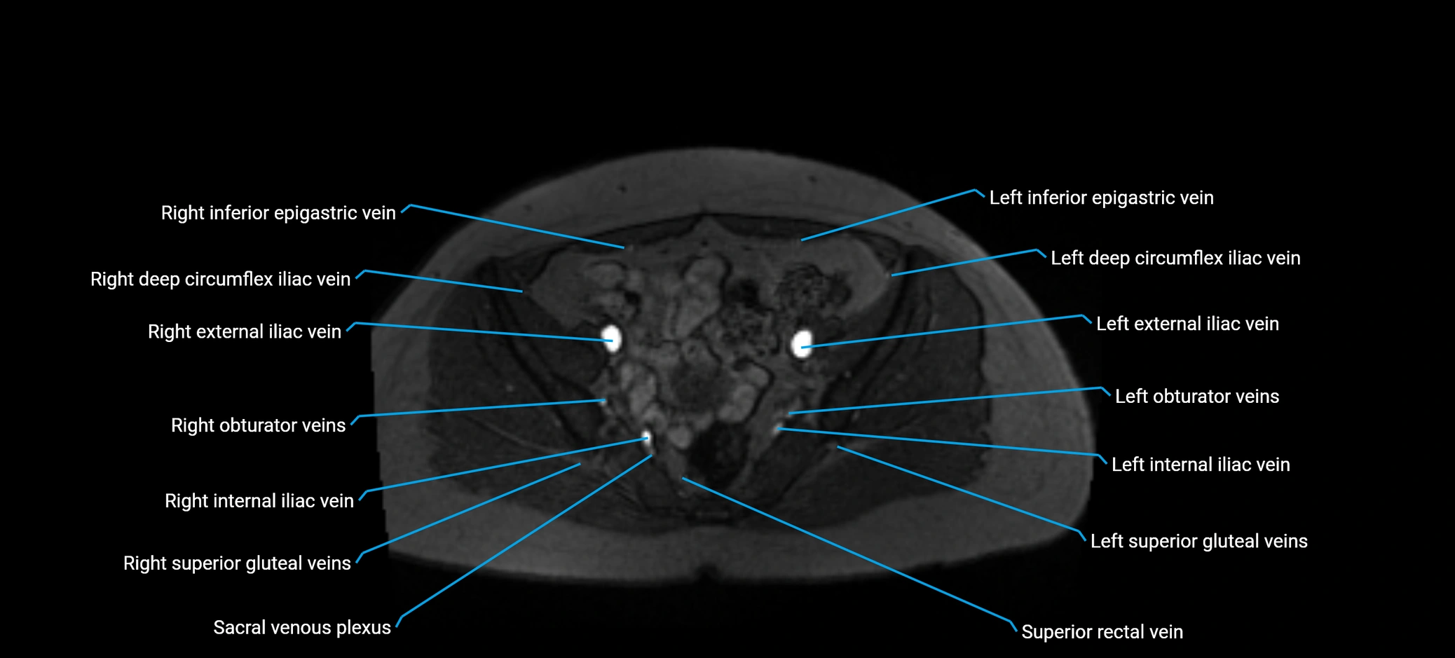 MRV abdomen pelvis & lower limb axial cross sectional anatomy labelled MRI image 152 (1).webp
